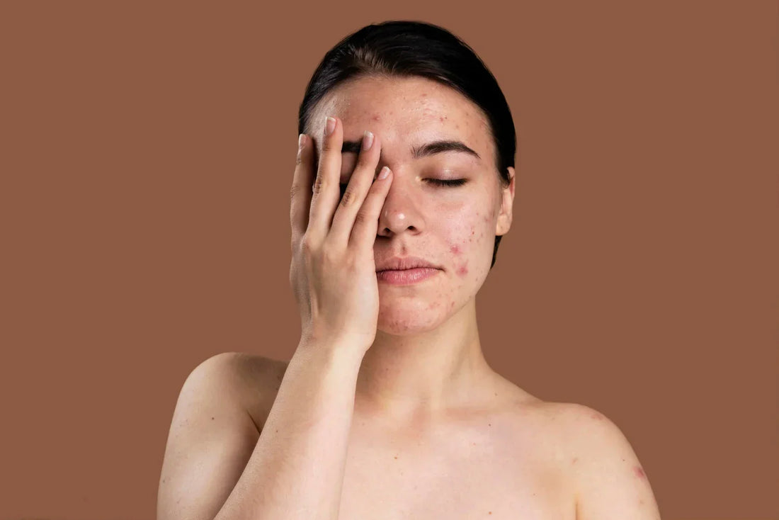 Skin Barrier Damage