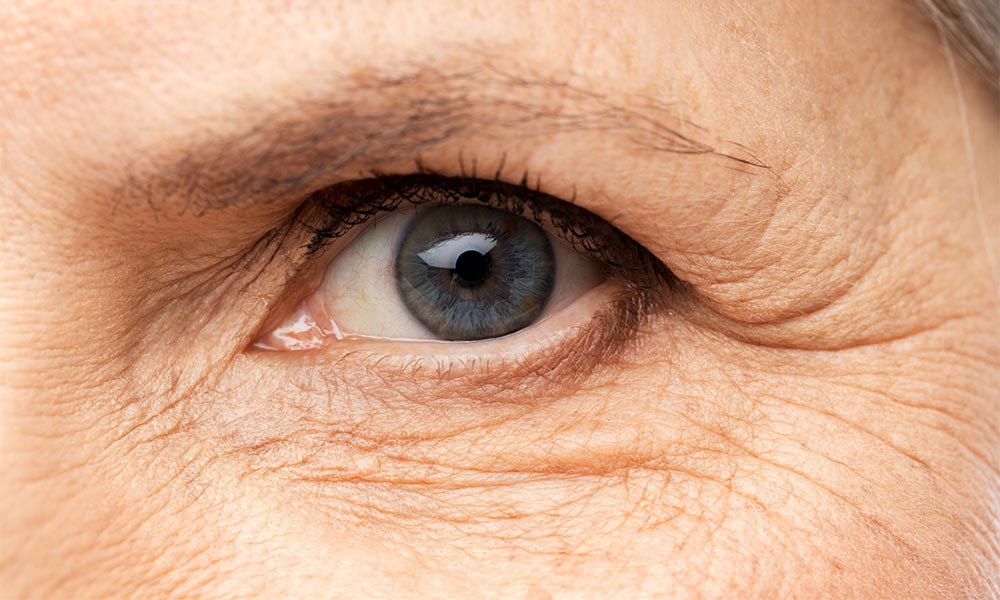 Multiple Signs of Ageing & Deep Wrinkles